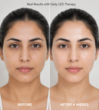 LED Facial Mask – Reduce Wrinkles, Acne & Dark Spots at Home